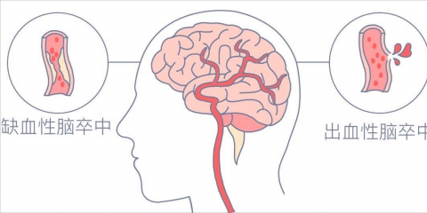 牢记两大口诀，尽早识别急性脑血管疾病——“脑卒中”